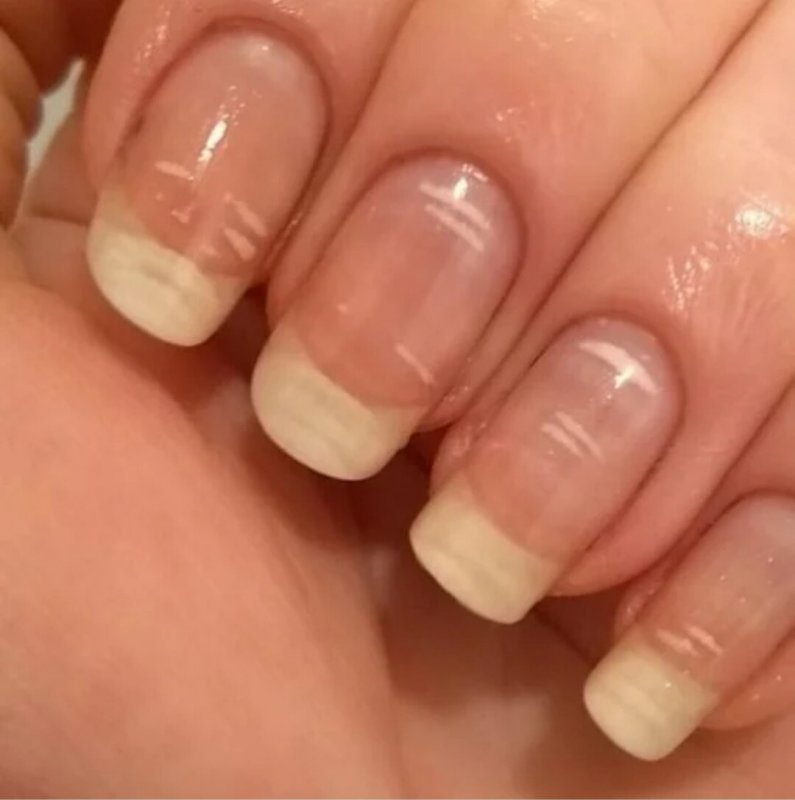 Микотическая лейконихия