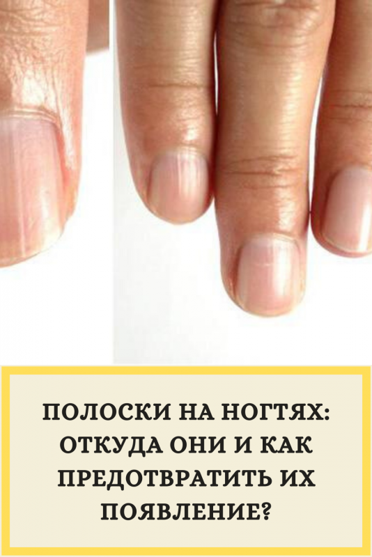 Выпуклая полоска на ногте