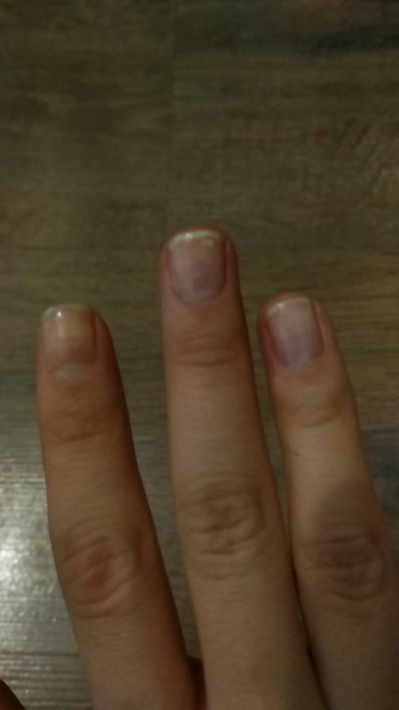 Белое пятно на ногте большого пальца
