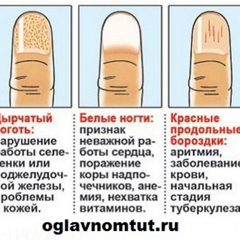 Микотическая лейконихия