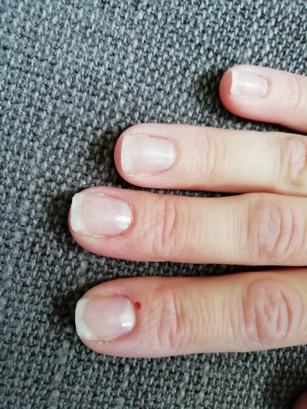 Пятно на ногте у ребенка