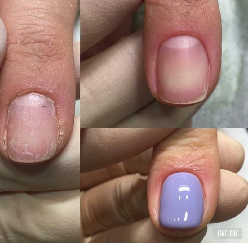 Отхождение ногтей после гель лака