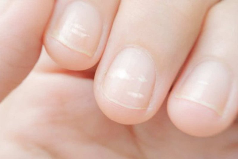Микотическая лейконихия
