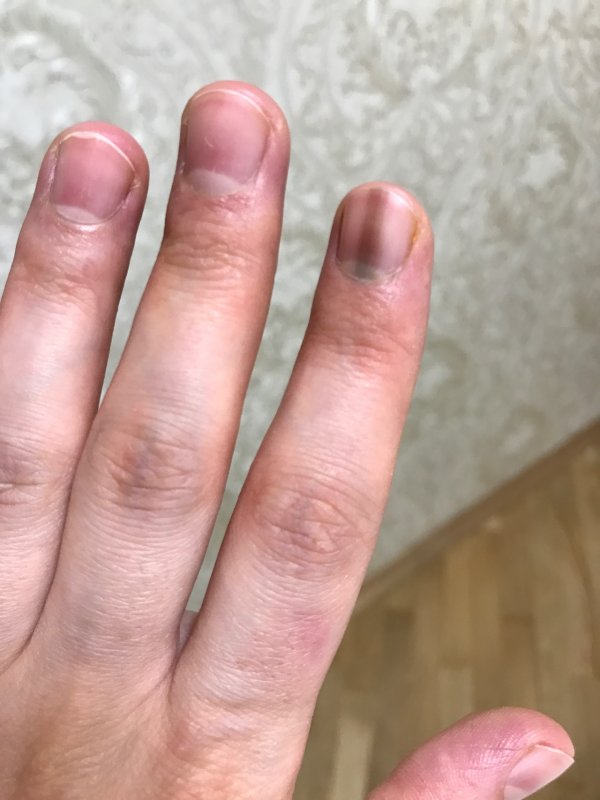 Меланома ногтя на большом пальце