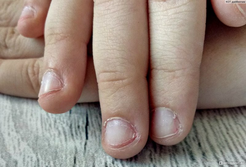Короткие ногти сгрызенные