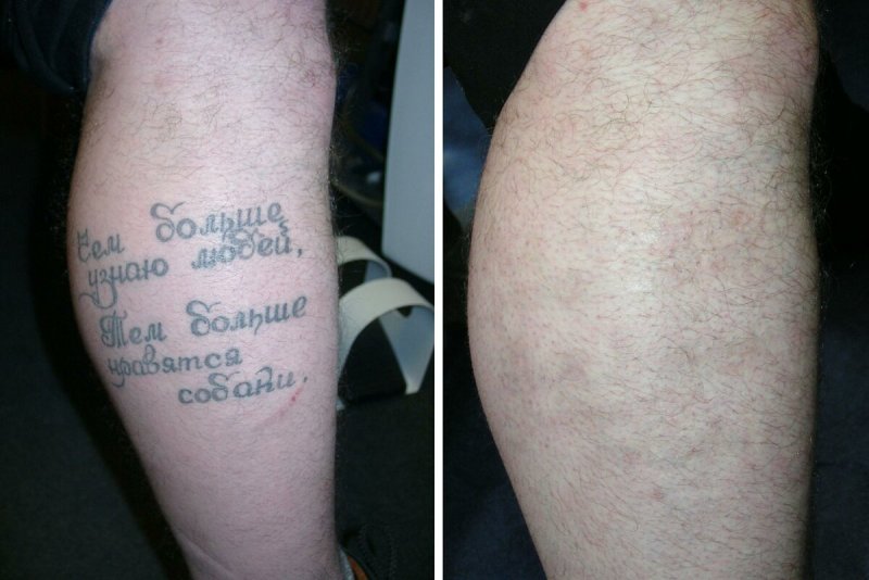 Сведение тату лазером результат