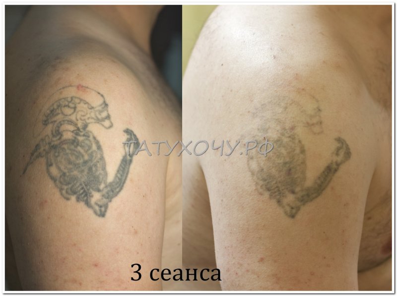 Сведение тату Хабаровск