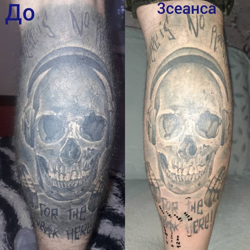 Удаление тату до и после