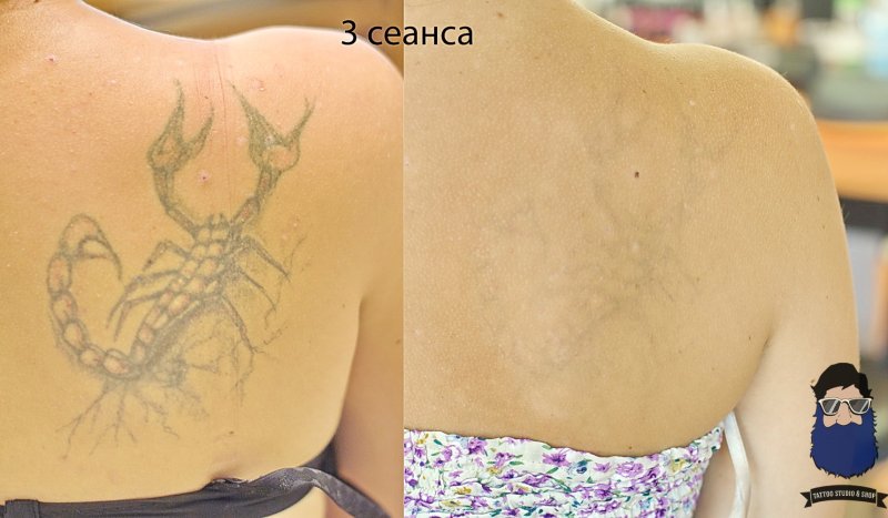 Сведение Татуировки чистотелом