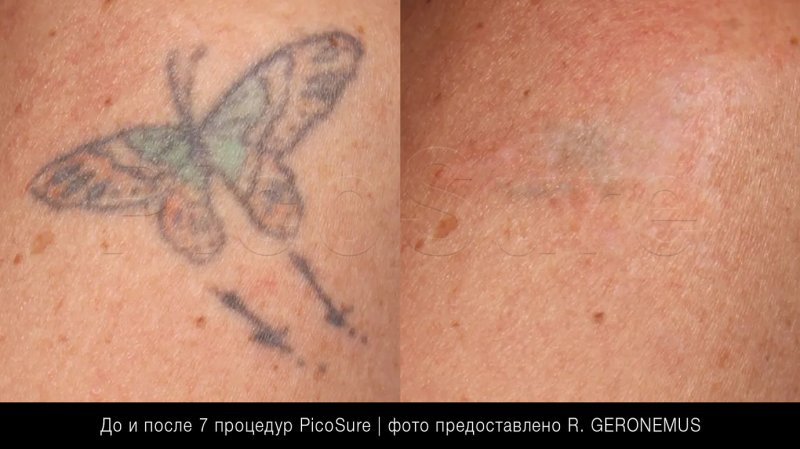 Сведение тату с пальца