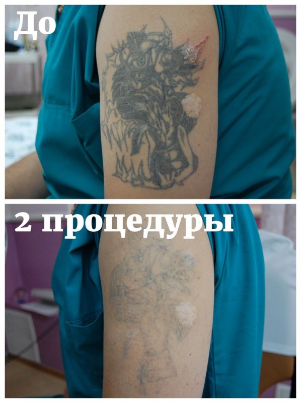 Татуировка после удаления лазером Picosure
