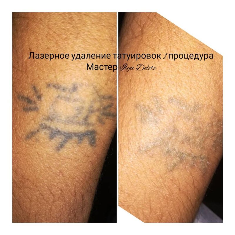 Крем для выведения наколок