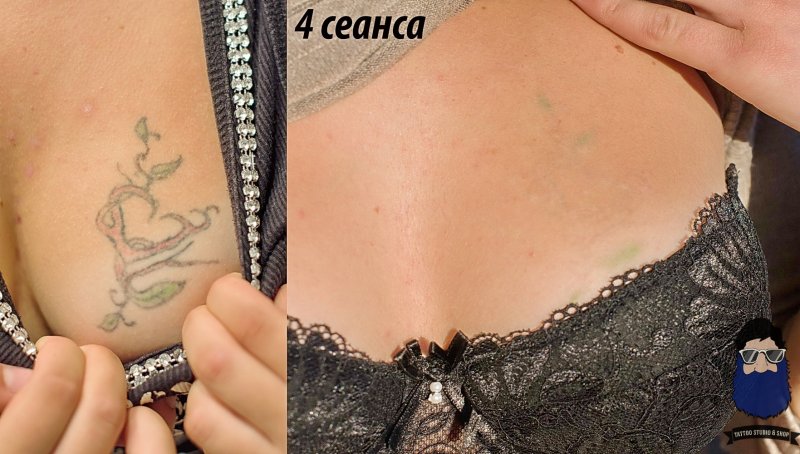 Лазерное удаление тату