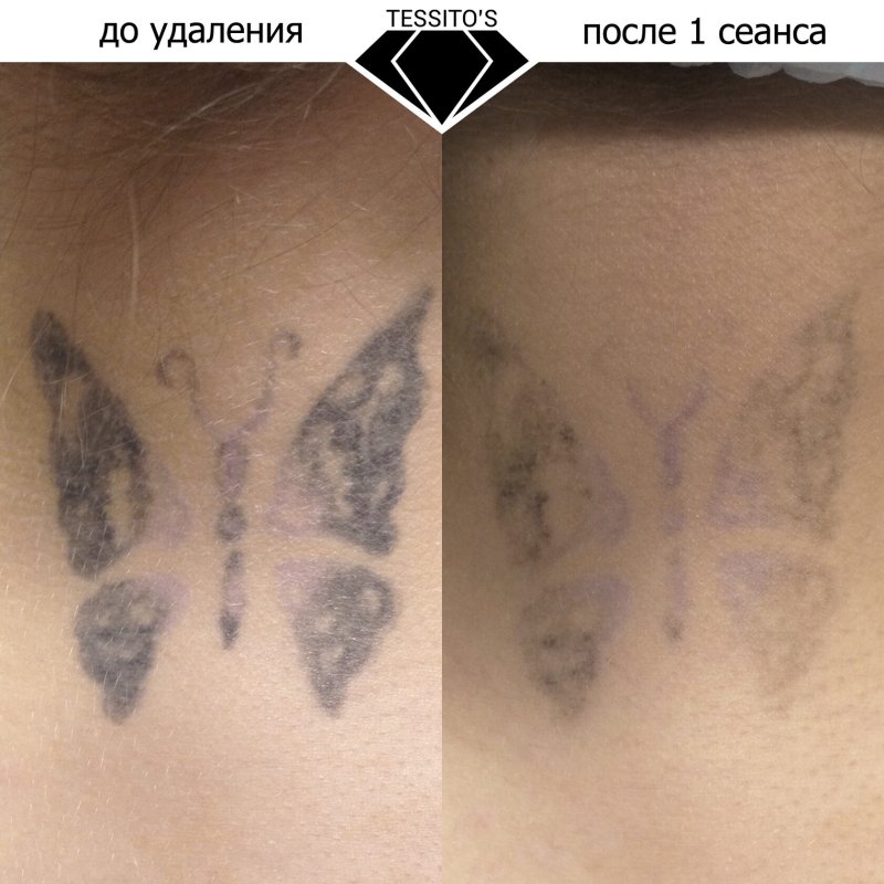 Удаленная лазером татуха