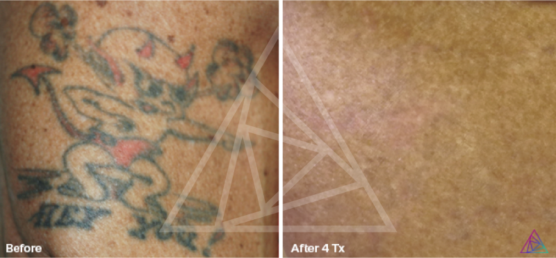 Tattoo Blowout