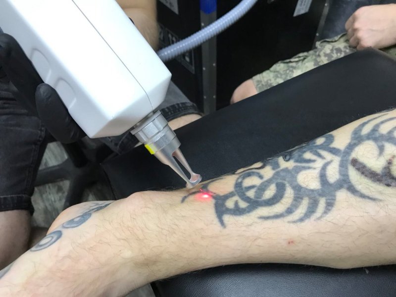 Рука после сведения тату