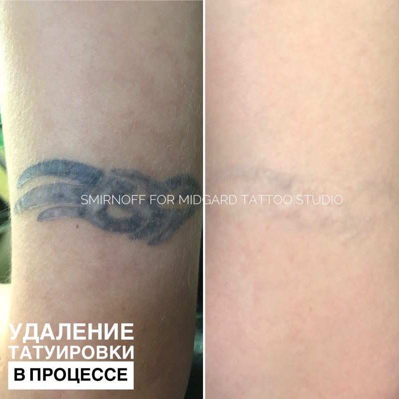 Хирургическое удаление татуировок