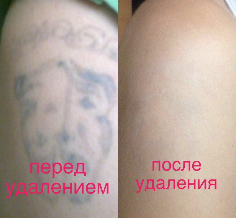 Заживление цветной тату