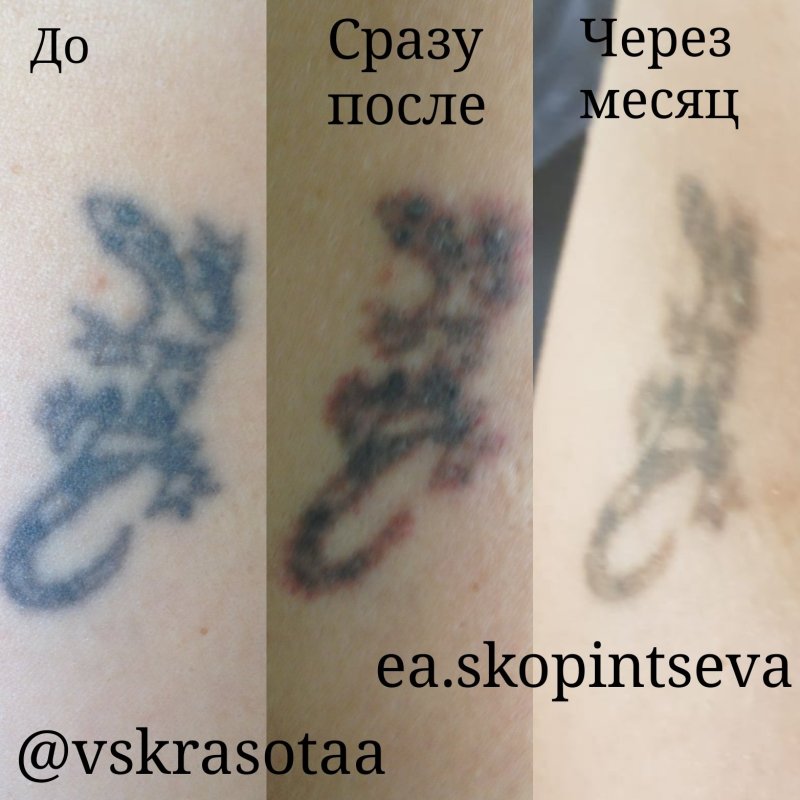Тату на шрамах на молочной железе