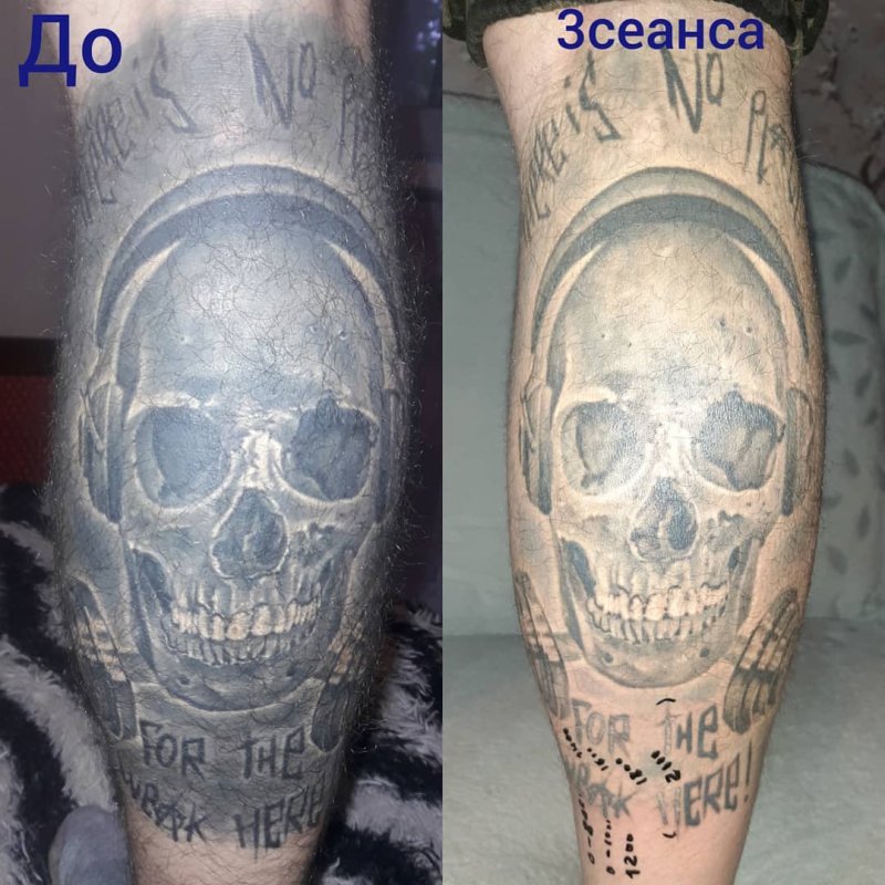Неудачное заживление тату