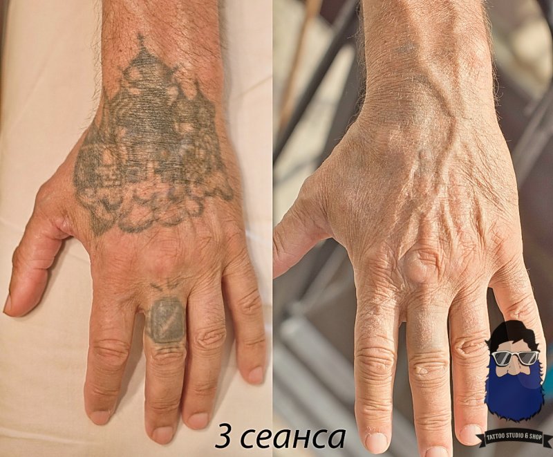 Сведение тату лазером Екатеринбург