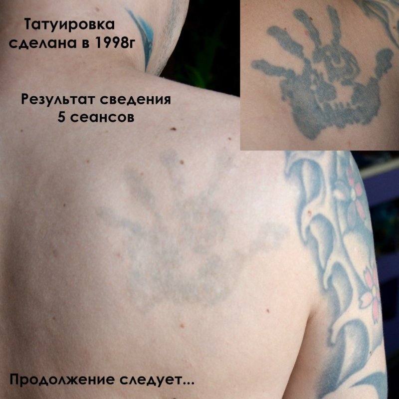 Тату после сведения лазером
