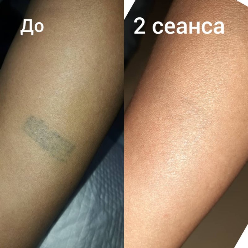 Рука после сведения тату