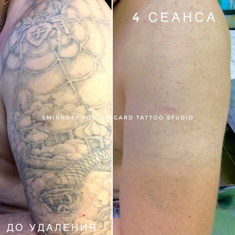 Рубцы после сведения тату