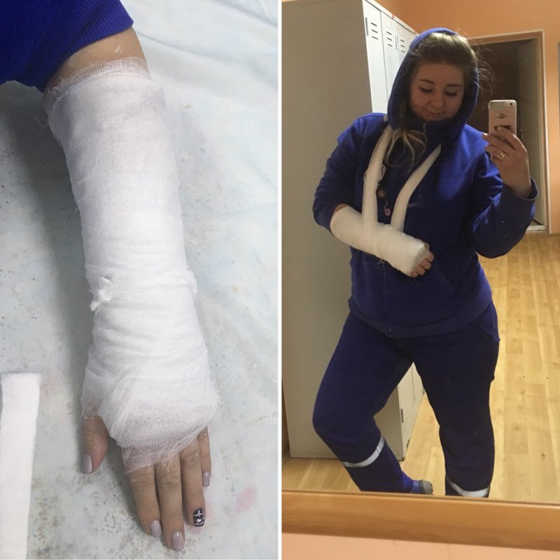 Перелом руки у подростка