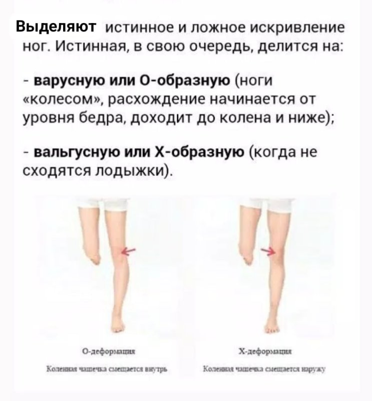 Исправление о образных ног
