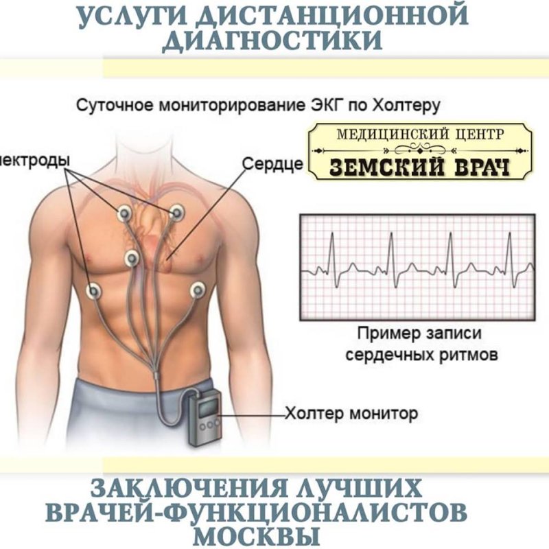 Холтеровское мониторирование